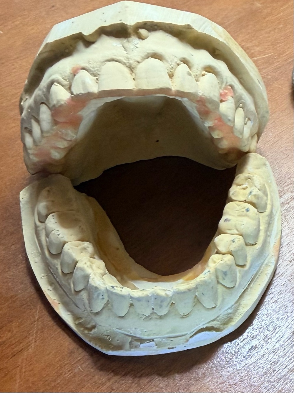 Dental Plaster Casts
